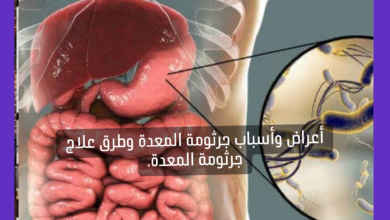 أعراض وأسباب جرثومة المعدة