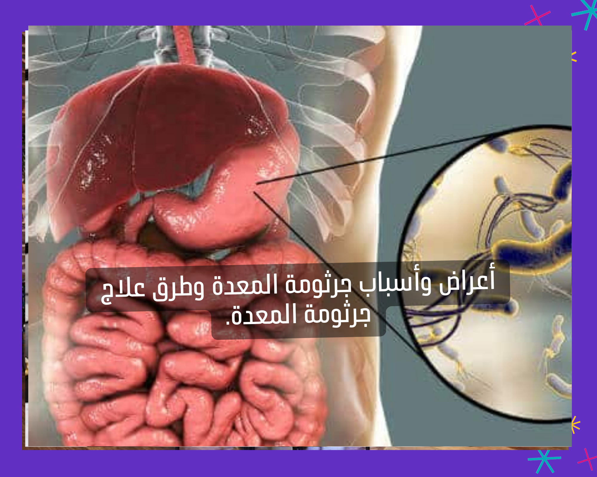 أعراض وأسباب جرثومة المعدة